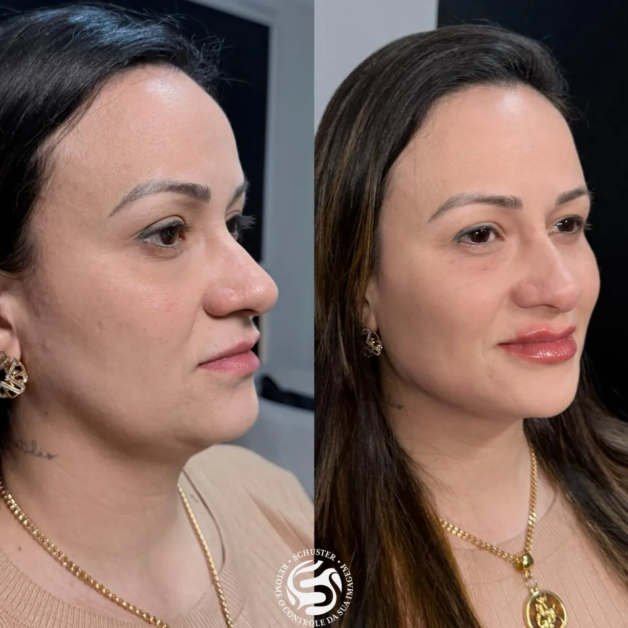 Antes e depois de uma paciente da Schuster Clinic, resultado 04
