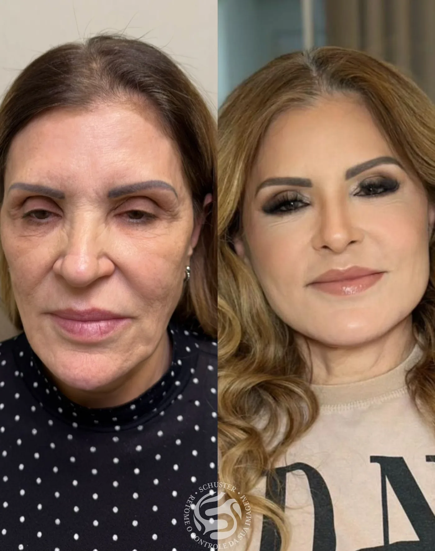Antes e depois de uma paciente da Schuster Clinic, resultado 08